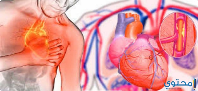 علاج مرض تصلب الشرايين بأحدث الطرق