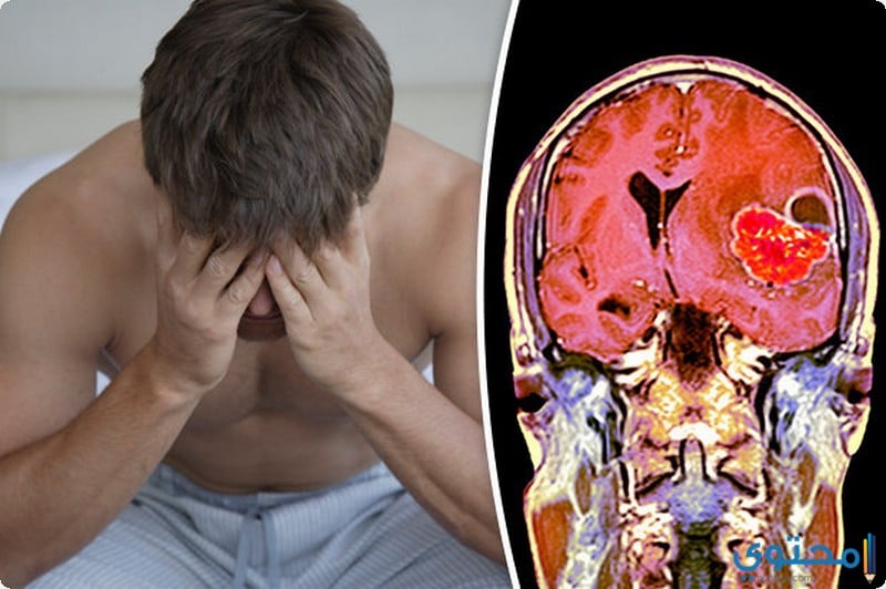 طرق علاج مرض أورام المخ